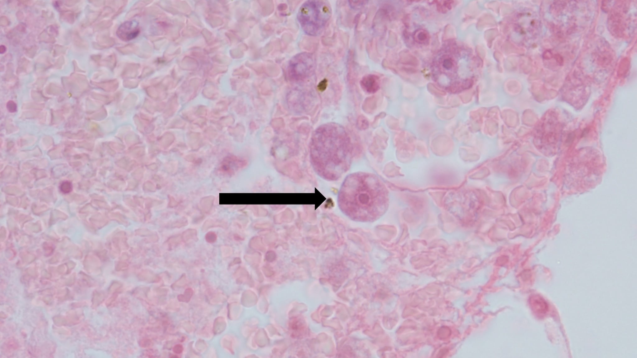 High resolution of Acanthamoeba in a patient's brain.