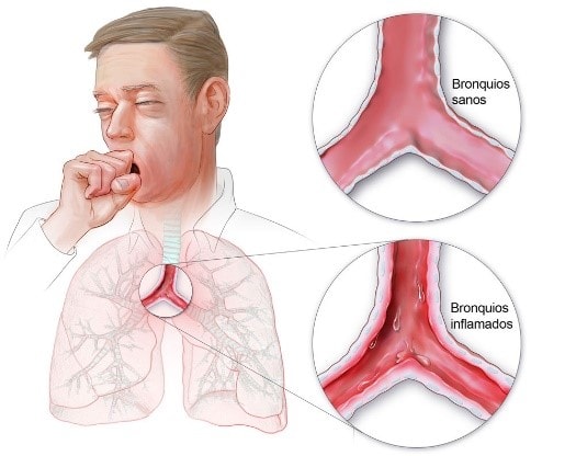 This image depicts the difference between a healthy lung air passage and an unhealthy lung air passage.