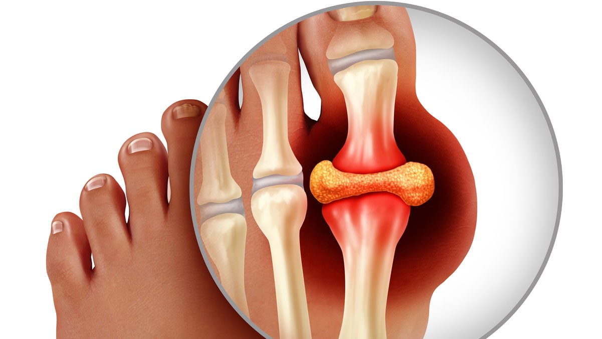 Illustration of uric acid buildup in between two joints of the big toe showing swelling, redness, and pain