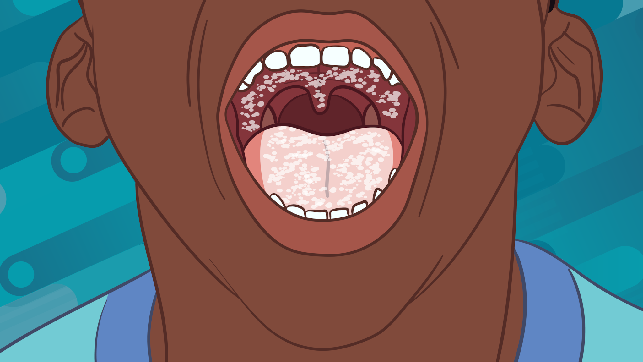 Candidiasis in the mouth