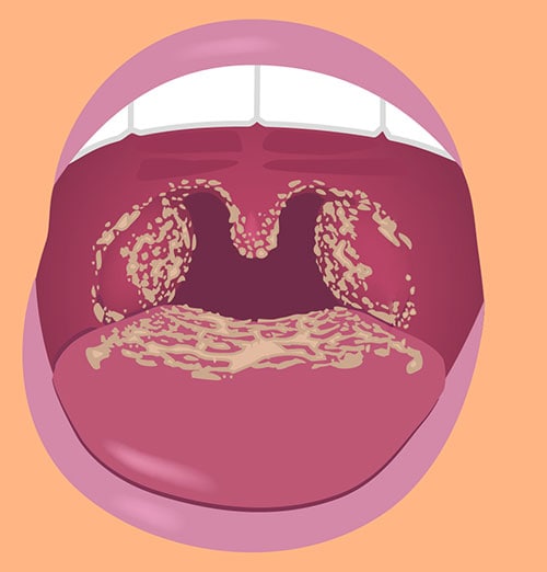 Illustration of open mouth with white patches in the back of the tongue and throat