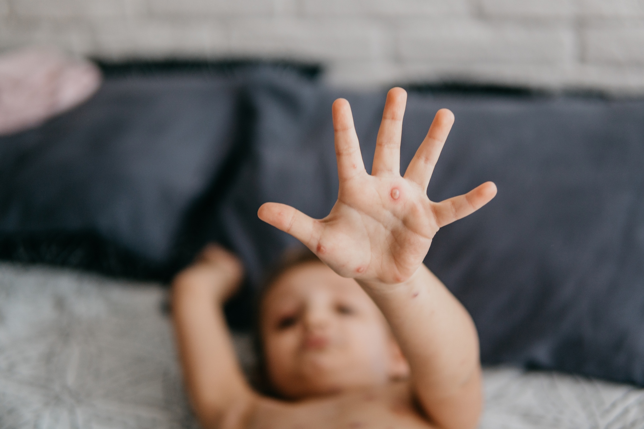 An infected toddler blurred in background with an outstretched hand extended to show chickenpox.