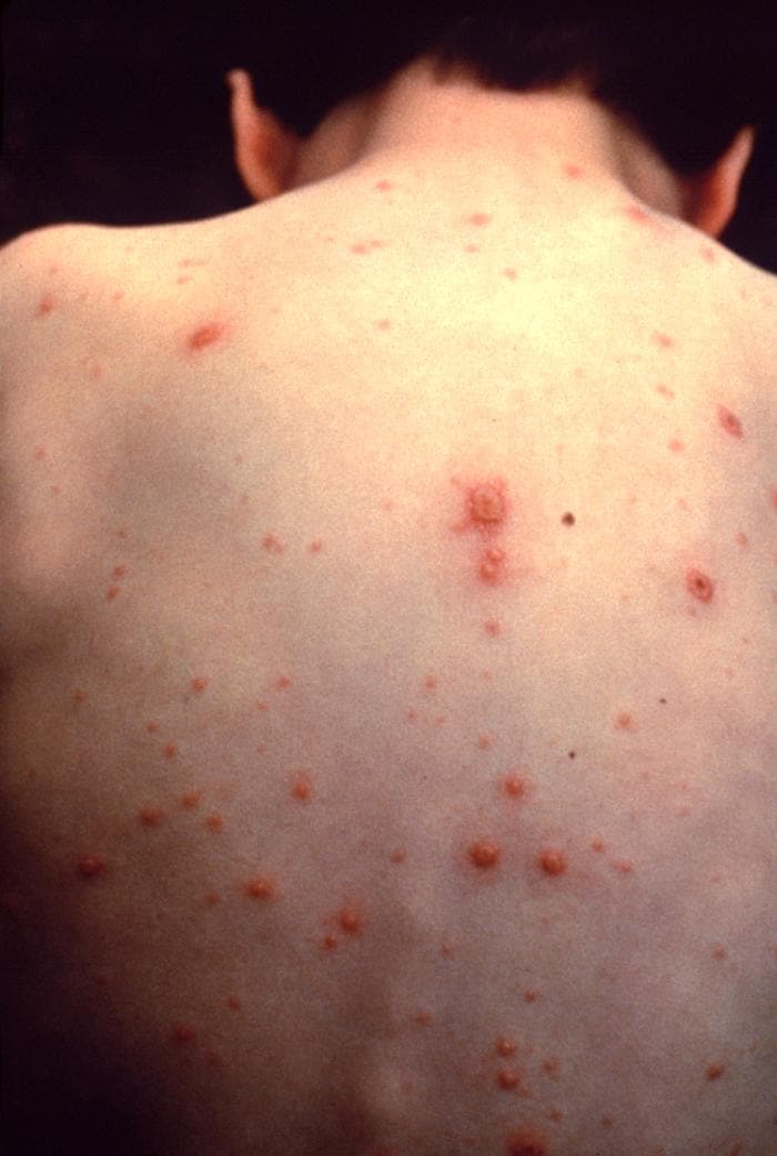 Chickenpox in unvaccinated child with light skin. Source: PHIL Photo ID# 6121