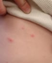 Vaccinated child with light skin with breakthrough varicella on the abdomen.  Source: Varicella Active Surveillance Project.