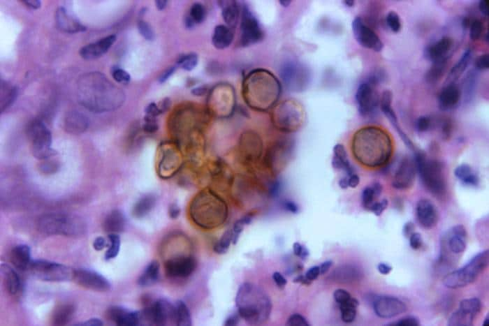 Characteristic pigmented fungal cells of chromoblastomycosis