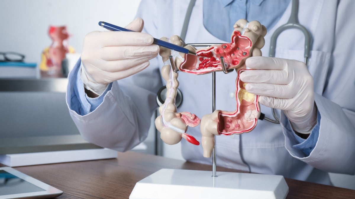 a doctor showing an model of the colon