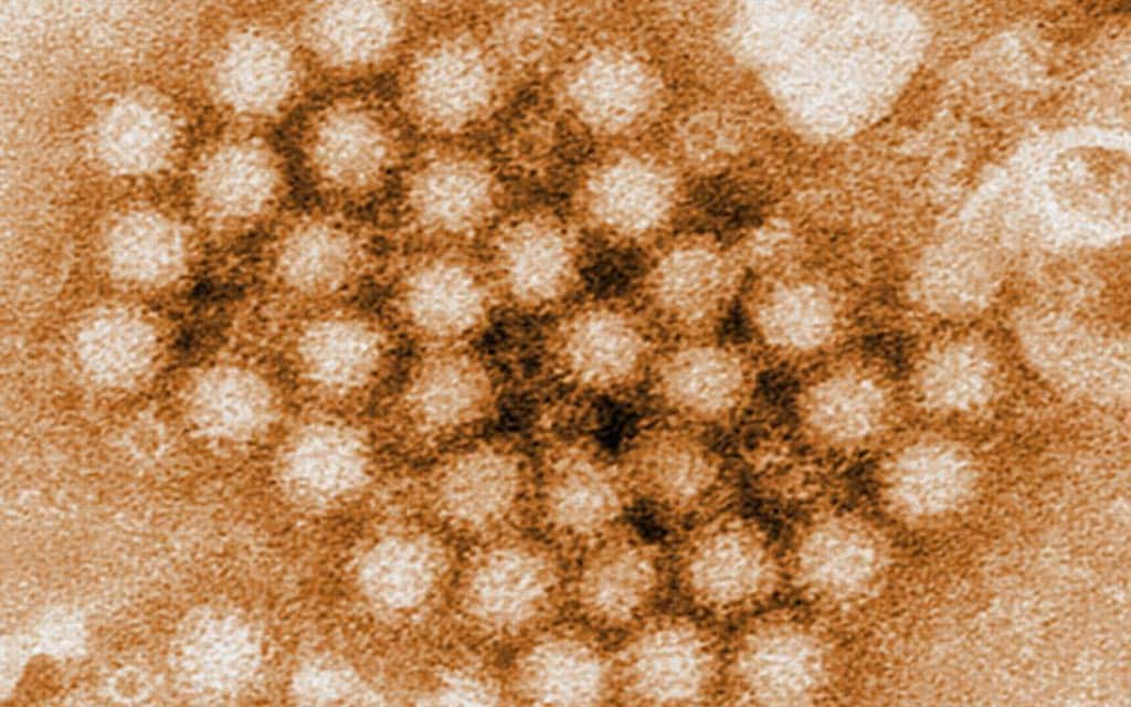 Norovirus detected by a transmission electron micrograph (TEM).