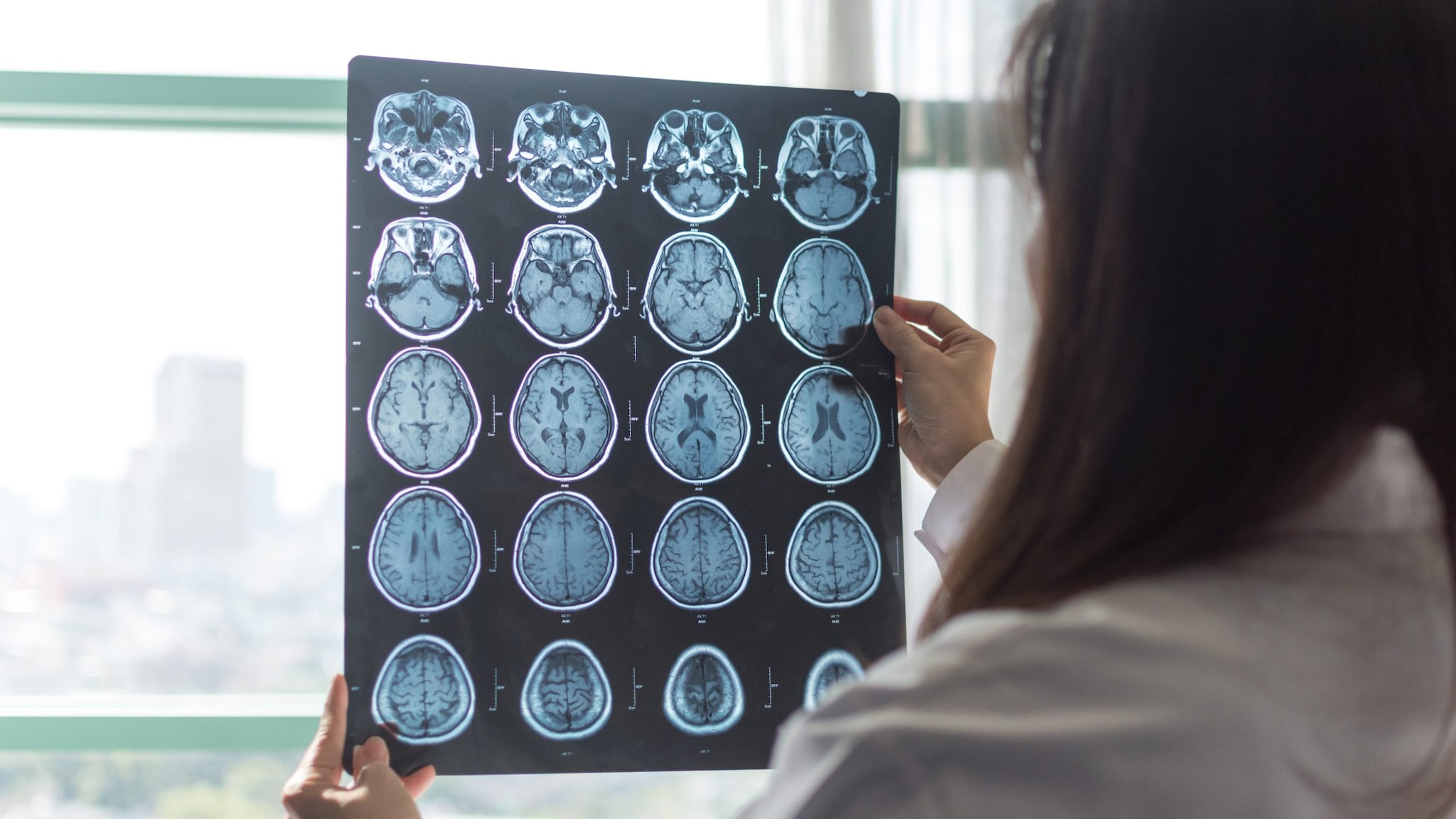 Doctor holding up a brain scan to a window