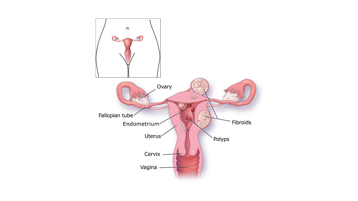 Aparato reproductor de la mujer, con pólipos y fibromas uterinos.