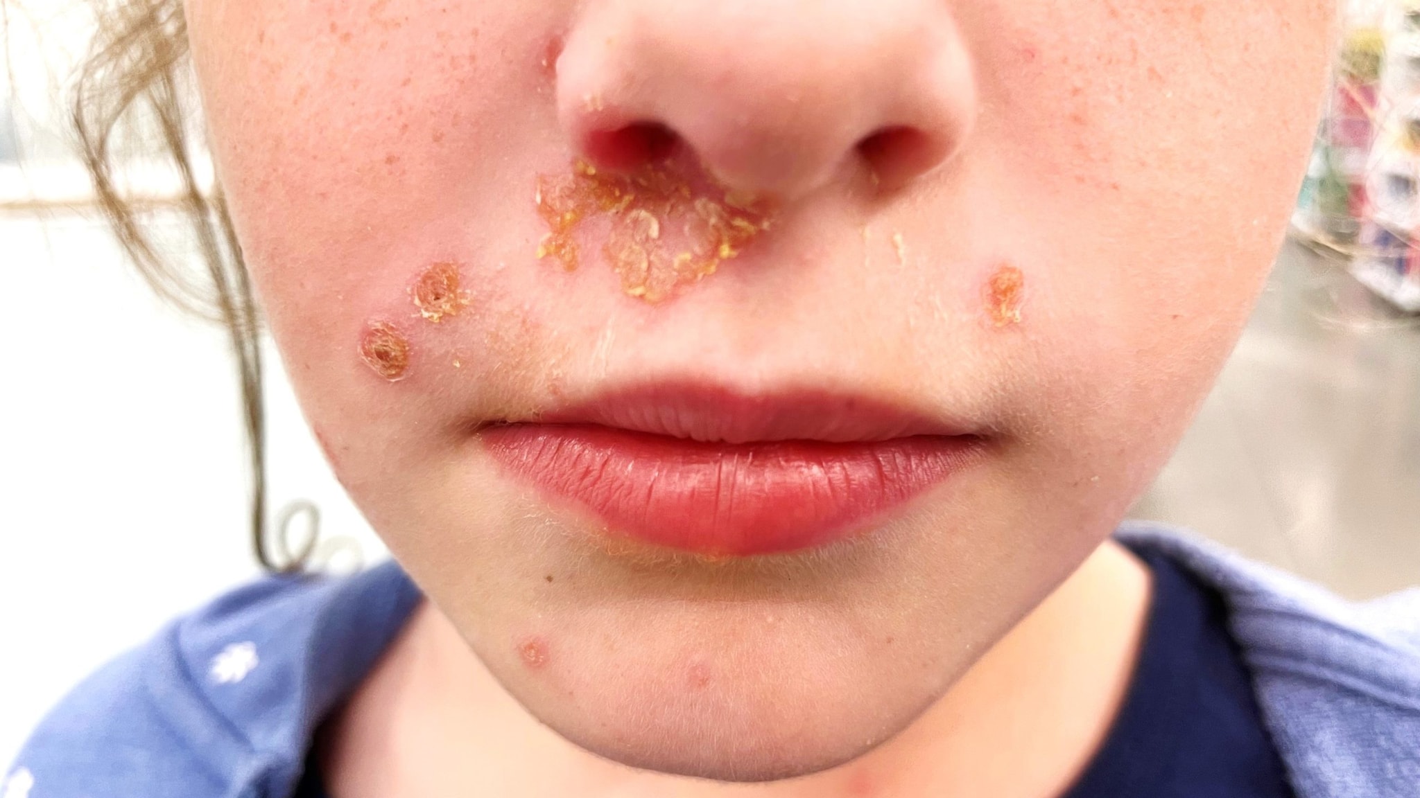 Costras de "color miel" en el rostro de una niña en edad escolar.