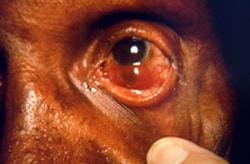 This patient presented in a clinical setting with a case of multibacillary leprosy. The photo shows one of the complications of this disease: staphyloma of the left eyeball. A staphyloma involves the protrusion of the wall of the eyeball, exhibiting a dark coloration due to the fact that the inner wall of the globe is pigmented and pushed towards its surface. This degeneration to the globe is a direct result of this illness.