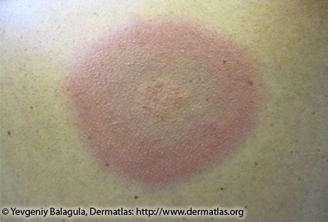 Close up image of a human's skin with a large red and blue colored rash and raised texture in the center.