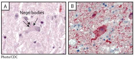 The figure shows photos from a histopathologic examination of central nervous system tissue from the autopsy of a decedent with suspected rabies infection in Indiana during 2009, showing neuronal cytoplasmic inclusions (Negri bodies) after hematoxylin and eosin staining and rabies virus antigen after immunohistochemical staining.