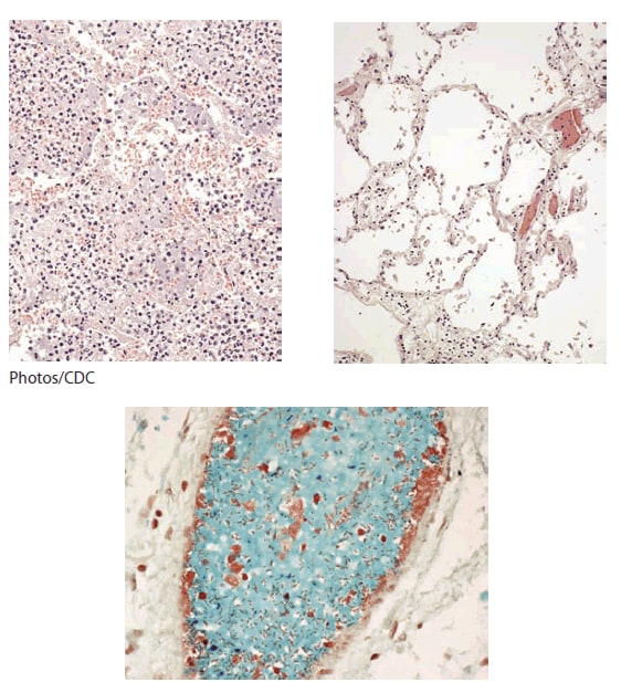 The figure shows pathologic findings indicating that the deceased researcher had septicemic plague, not pneumonic plague, in the fatal case of laboratory-acquired infection with an attenuated Yersinia pestis strain in Chicago in 2009.