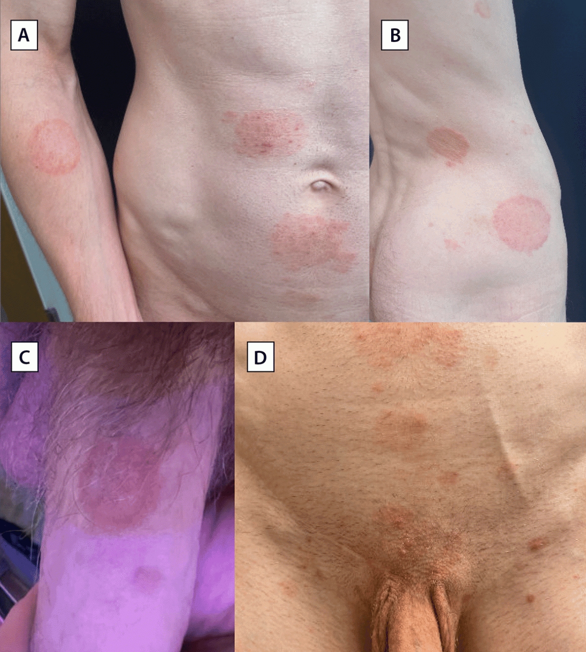 The figure comprises four photos illustrating clinical signs at initial dermatology evaluation for one of four patients with Trichophyton mentagrophytes genotype VII rash, with two photos showing tinea corporis, one showing tinea genitalis, and one showing both tinea corporis and tinea pubogenitalis, in New York City during April–July 2024.