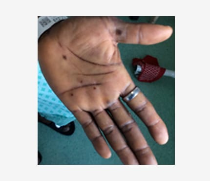 Photo of a dark-skinned person's hand with mpox lesions