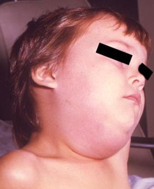 A child with swollen jaw, a characteristic of mumps.