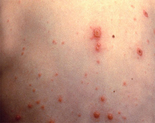 Chickenpox on back