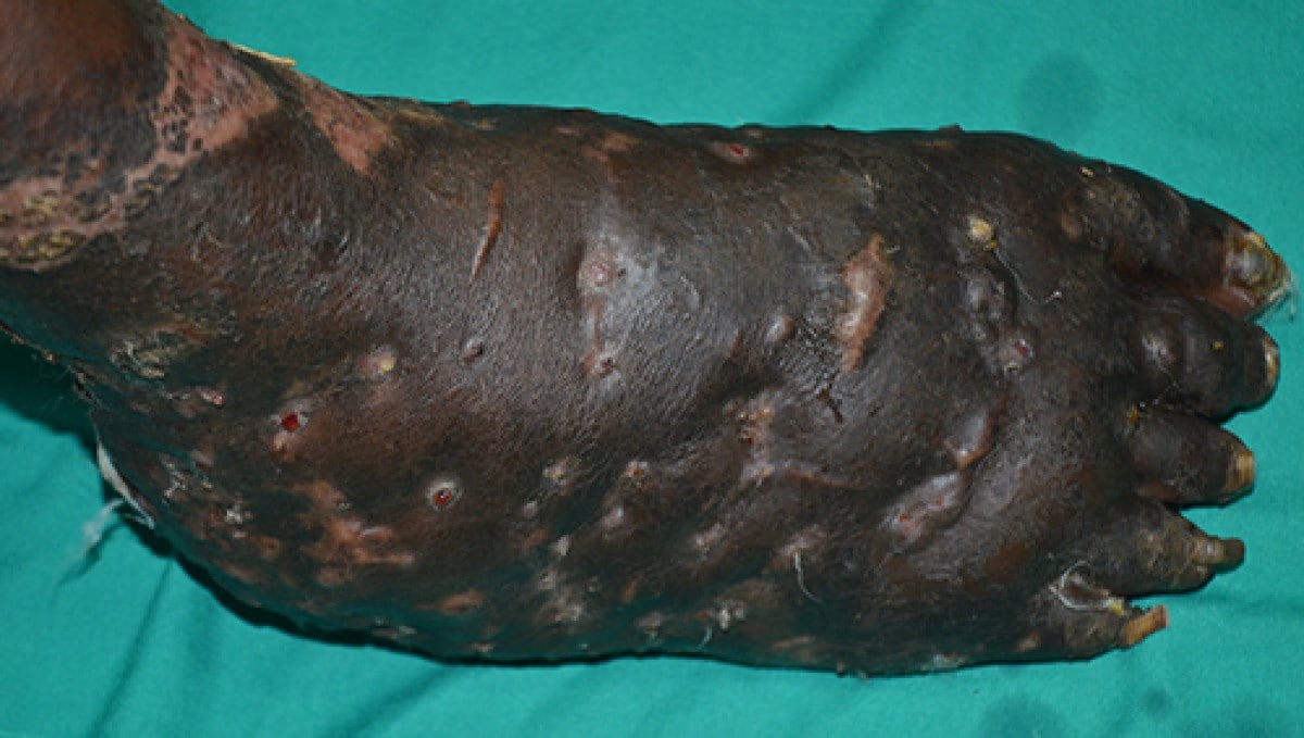 Photo of a foot affected by mycetoma