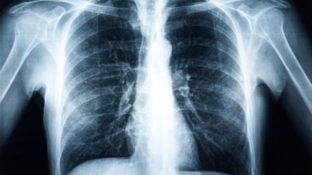 A chest x-ray.