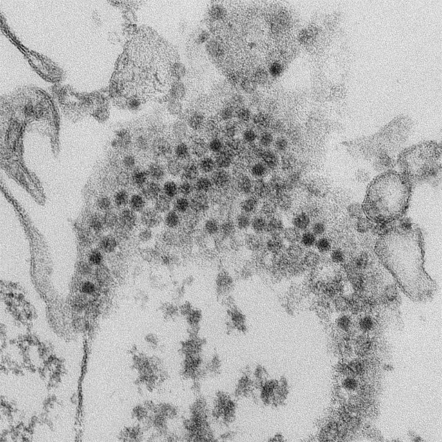 This thin section transmission electron micrograph (TEM) reveals numerous, spheroid-shaped Enterovirus-D68 (EV-D68) virions, which are members of the family Picornaviridae.