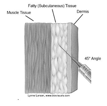 Image of needle entering fatty (subcutaneous) tissue, at 45-degree angle, through the dermis, stopping before the muscle tissue.