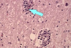 Microscope image of perivascular cuffing and inflamation around a blood vessel (Magnified 200x)