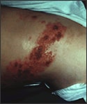 Person with large shingles rash on their waist.