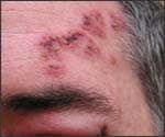 Shingles facial rash and swollen eyelids.