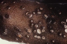 image of smallpox: Scabs Fall Off