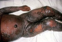 Eczema vaccinatum on the arms, torso, and legs of a child.