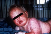 Generalized vaccinia in child.