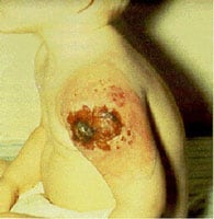 Fatal progressive vaccinia in a child with an immunodeficiency.