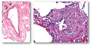Bronquiolo de un trabajador afectado que muestra patrones de bronquiolitis obliterante constrictiva.
