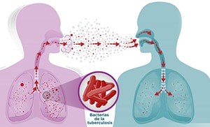 How tuberculosis spreads