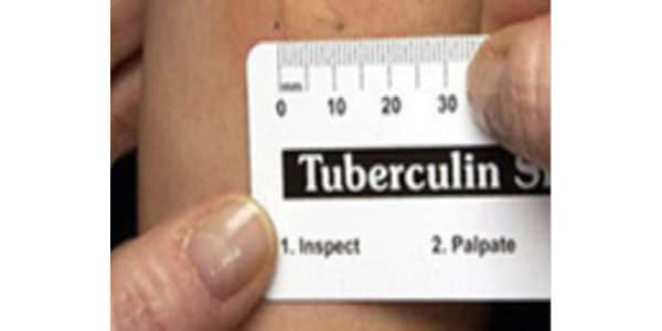 Ruler measuring induration on skin