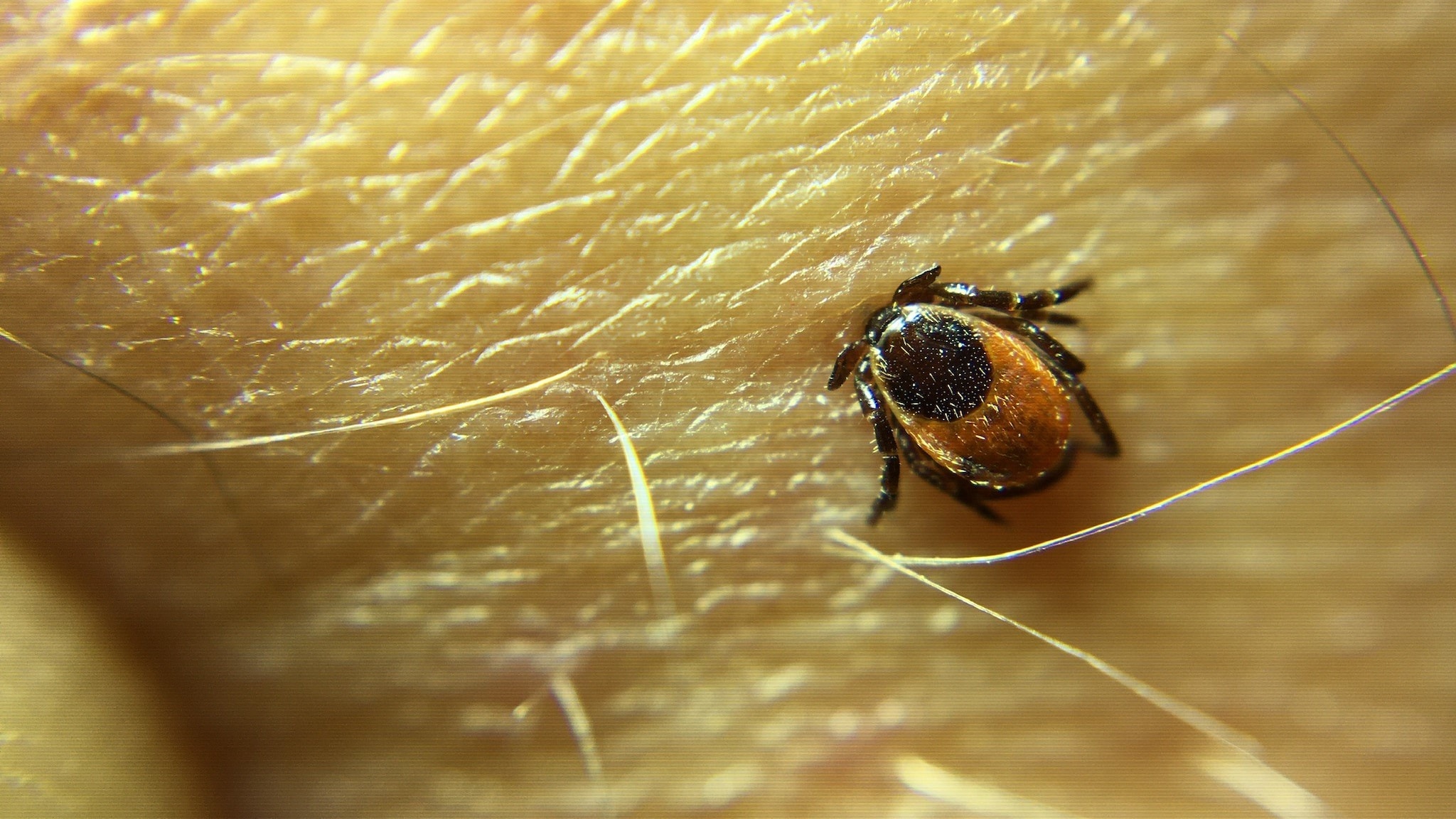 Blacklegged tick embedded in human skin.