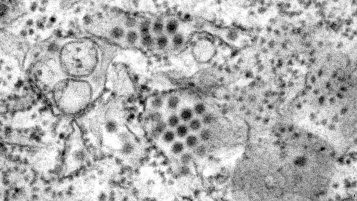 Dengue virus particles in a tissue specimen.