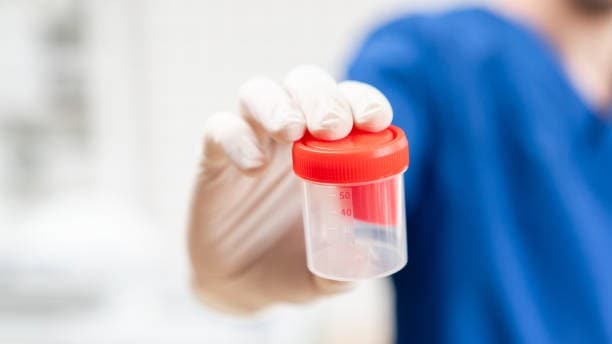 Nurse holding a urine cup