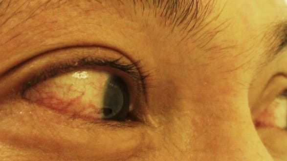 Foto de los ojos de una persona con conjuntivitis (ojos enrojecidos).