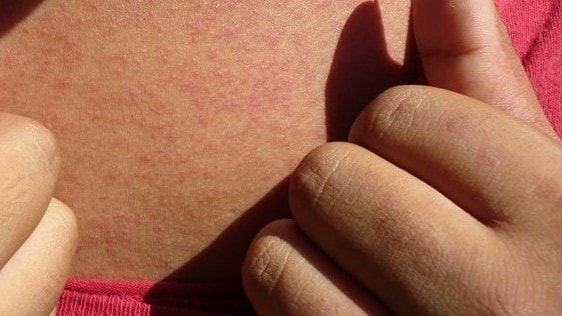 Fotografía de la piel de una persona con un sarpullido causado por el zika.